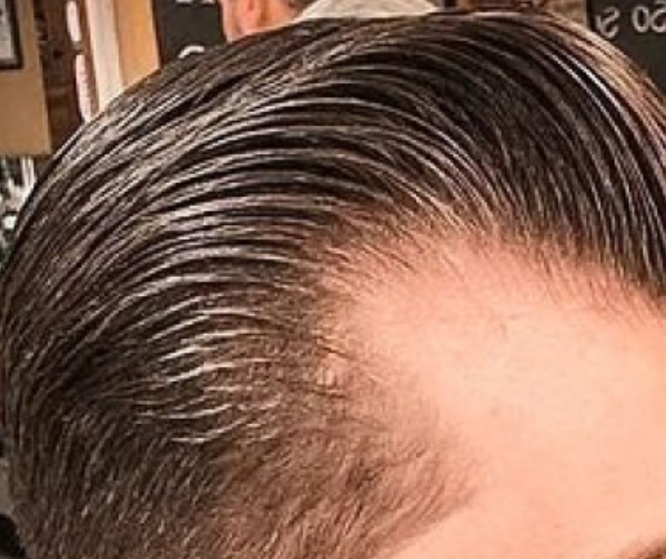 Pomada modeladora de cabelo leva mais de 100 para o hospital no Rio