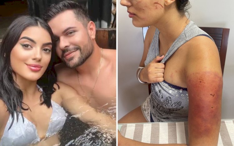 Mulher agredida por beber cerveja sem permissão do namorado desabafa após soltura do homem: ‘Muito assustada’